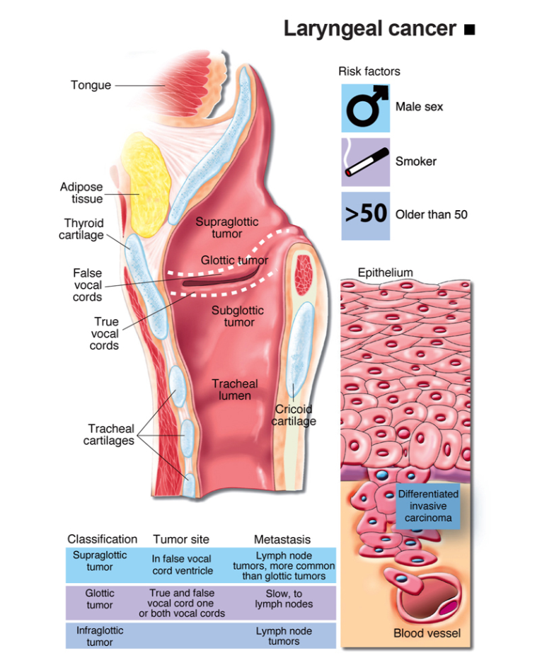 Infografis Laryngeal Cancer